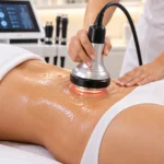 Cavitație – Clinica Ababi Radu Cluj-Napoca