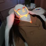 Mască laser / mască cu acid hialuronic – Clinica Ababi Radu București