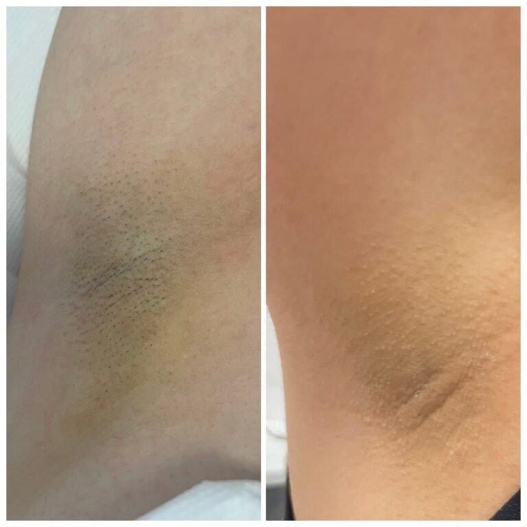 Rezultate epilare definitivă laser – înainte și după – Clinica Ababi Radu