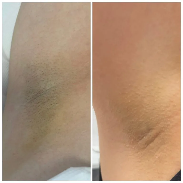 Rezultate epilare definitivă laser – înainte și după – Clinica Ababi Radu