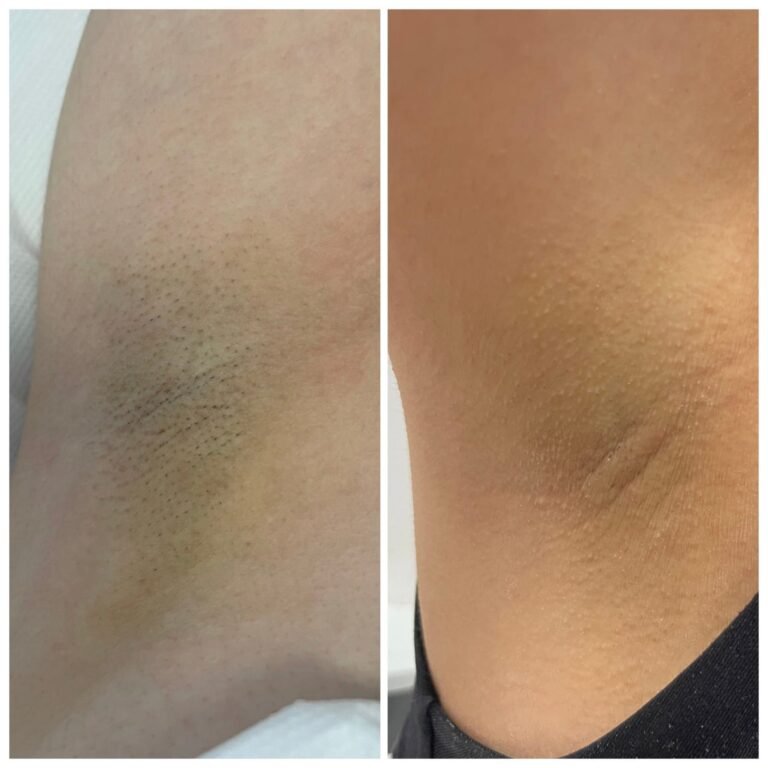 Rezultate epilare definitivă laser – înainte și după – Clinica Ababi Radu