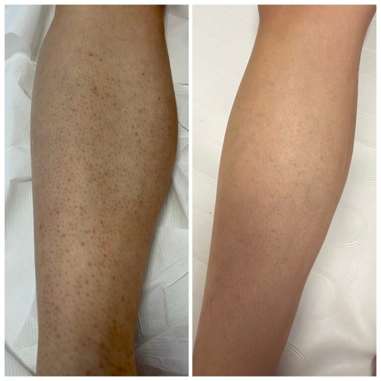 Rezultate epilare definitivă laser – înainte și după – Clinica Ababi Radu