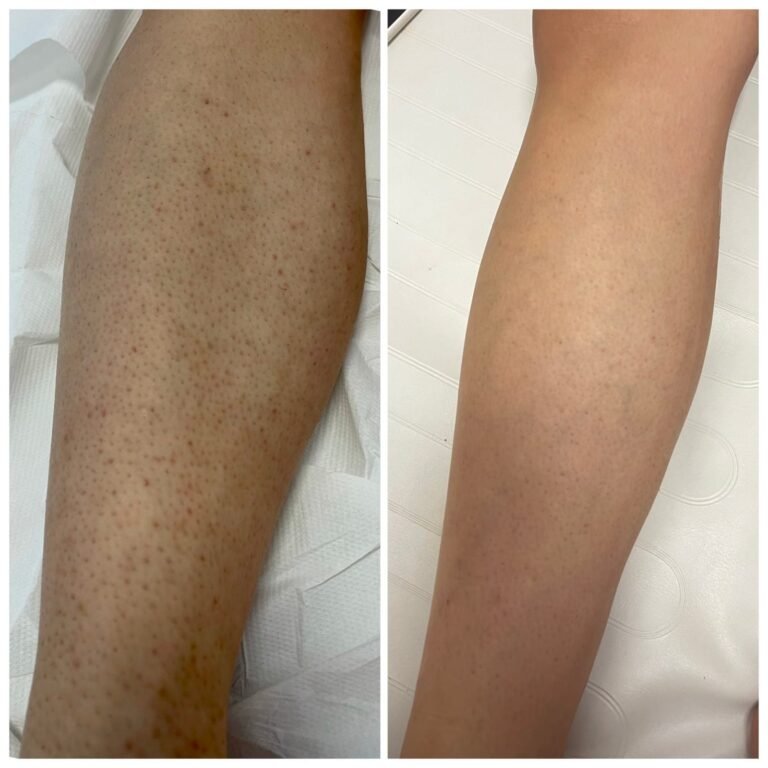 Rezultate epilare definitivă laser – înainte și după – Clinica Ababi Radu
