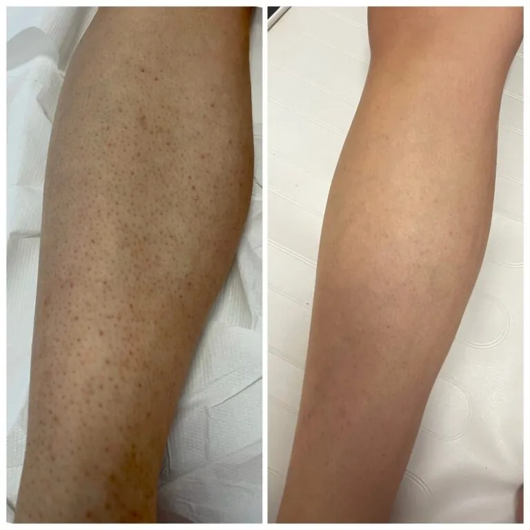 Rezultate epilare definitivă laser – înainte și după – Clinica Ababi Radu