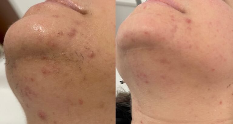 Rezultate epilare definitivă laser – înainte și după – Clinica Ababi Radu