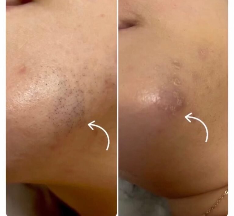 Rezultate epilare definitivă laser – înainte și după – Clinica Ababi Radu