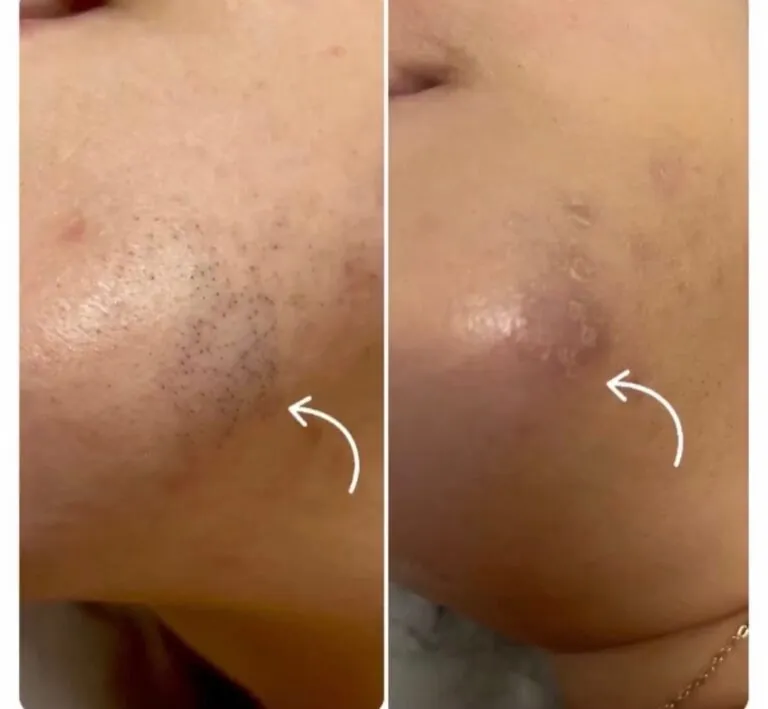 Rezultate epilare definitivă laser – înainte și după – Clinica Ababi Radu