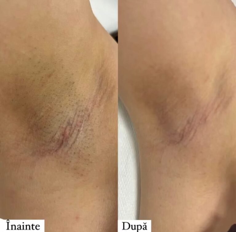 Rezultate epilare definitivă laser – înainte și după – Clinica Ababi Radu