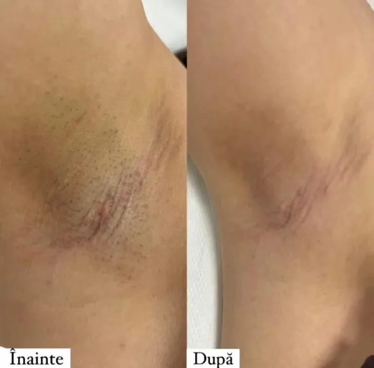 Rezultate epilare definitivă laser – înainte și după – Clinica Ababi Radu