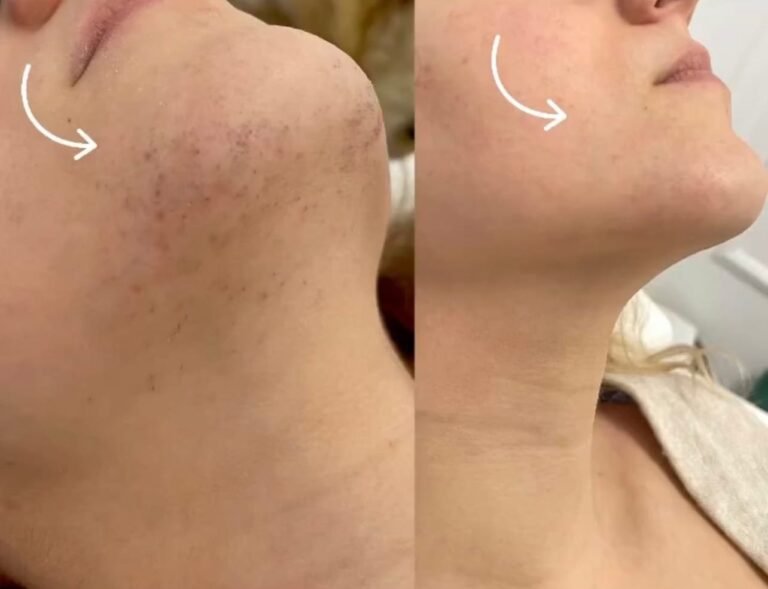 Rezultate epilare definitivă laser – înainte și după – Clinica Ababi Radu