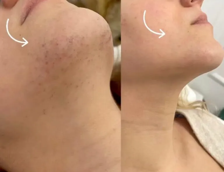 Rezultate epilare definitivă laser – înainte și după – Clinica Ababi Radu