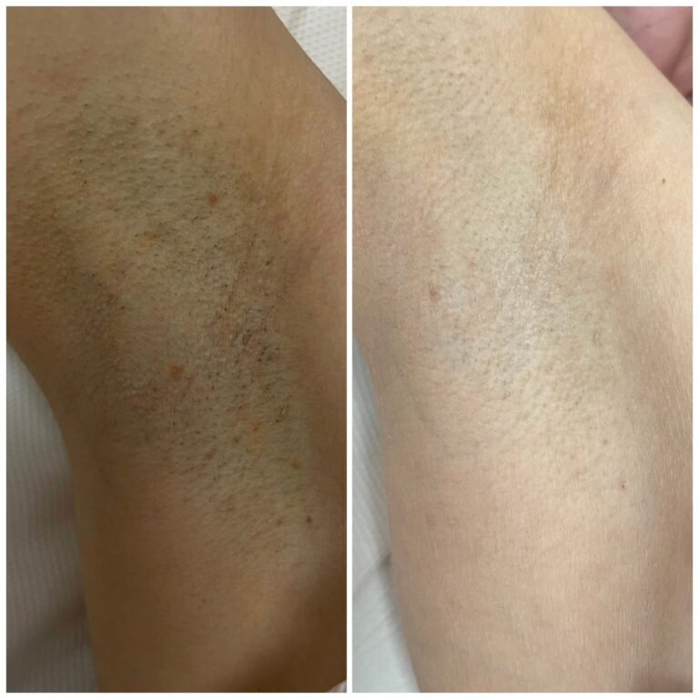 Rezultate epilare definitivă laser – înainte și după – Clinica Ababi Radu