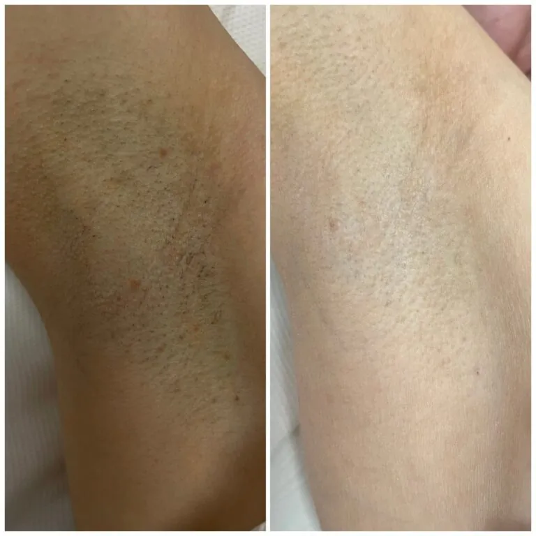 Rezultate epilare definitivă laser – înainte și după – Clinica Ababi Radu