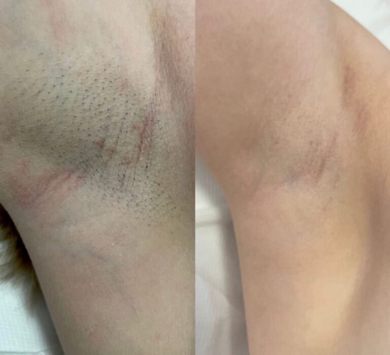 Rezultate epilare definitivă laser – înainte și după – Clinica Ababi Radu