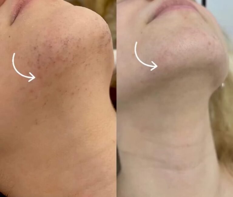 Rezultate epilare definitivă laser – înainte și după – Clinica Ababi Radu