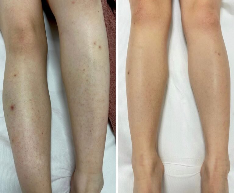 Rezultate epilare definitivă laser – înainte și după – Clinica Ababi Radu
