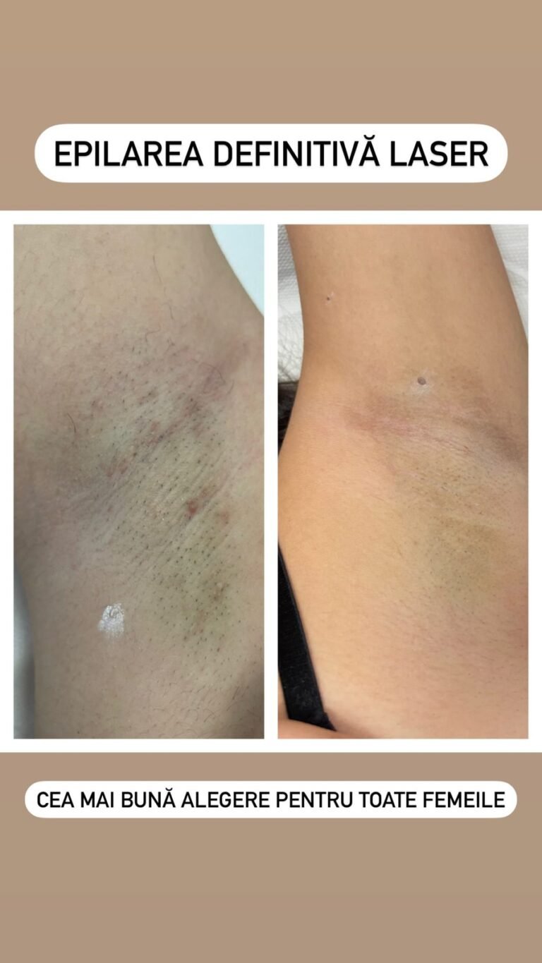 Rezultate epilare definitivă laser – înainte și după – Clinica Ababi Radu