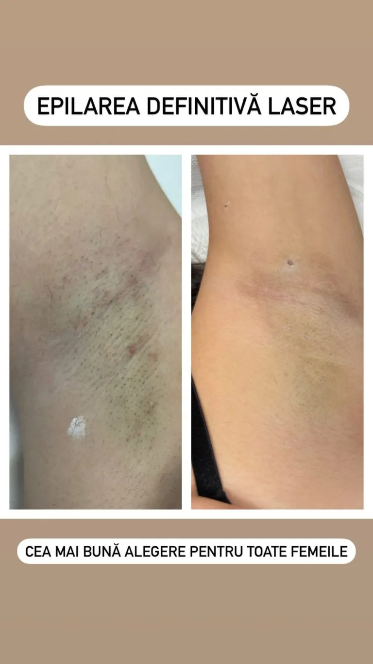 Rezultate epilare definitivă laser – înainte și după – Clinica Ababi Radu