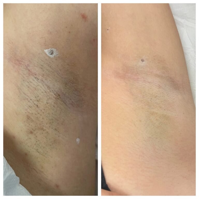 Rezultate epilare definitivă laser – înainte și după – Clinica Ababi Radu