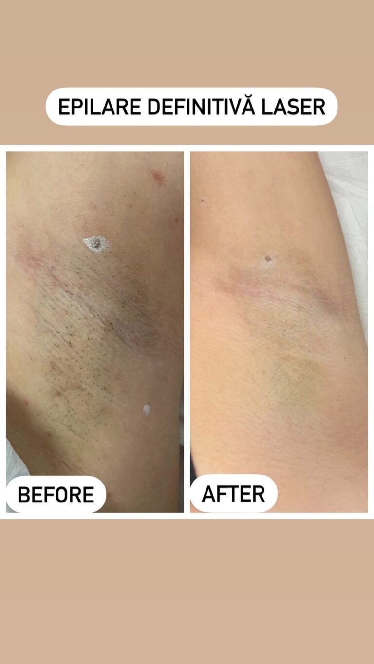 Rezultate epilare definitivă laser – înainte și după – Clinica Ababi Radu