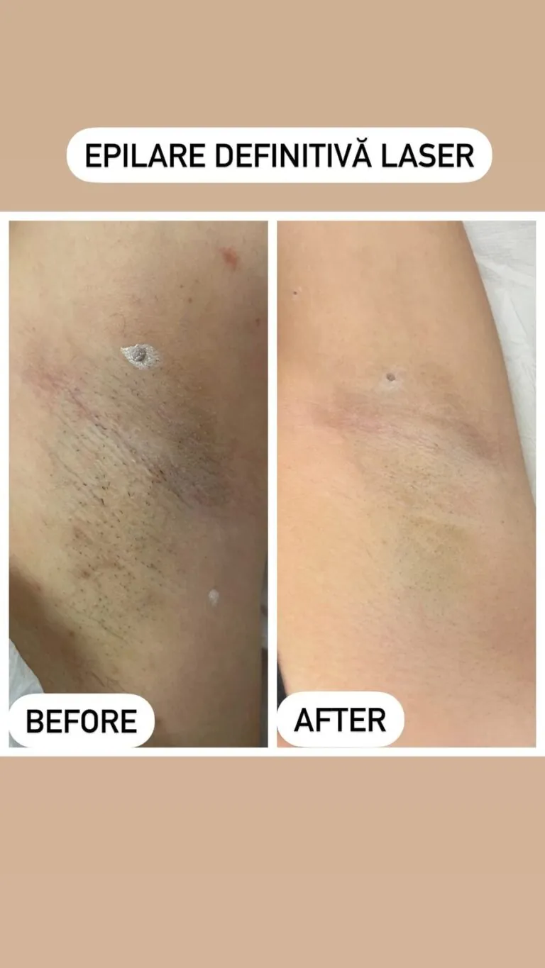 Rezultate epilare definitivă laser – înainte și după – Clinica Ababi Radu