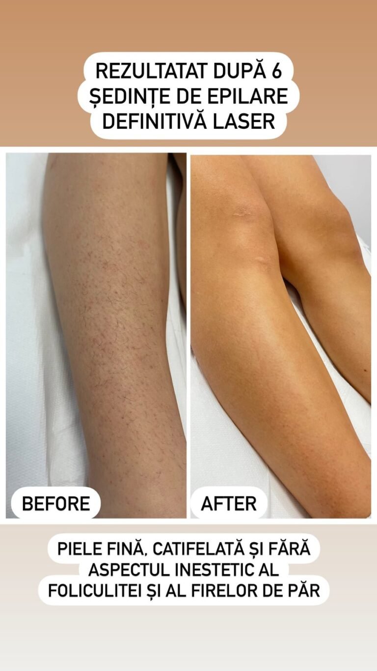 Rezultate epilare definitivă laser – înainte și după – Clinica Ababi Radu