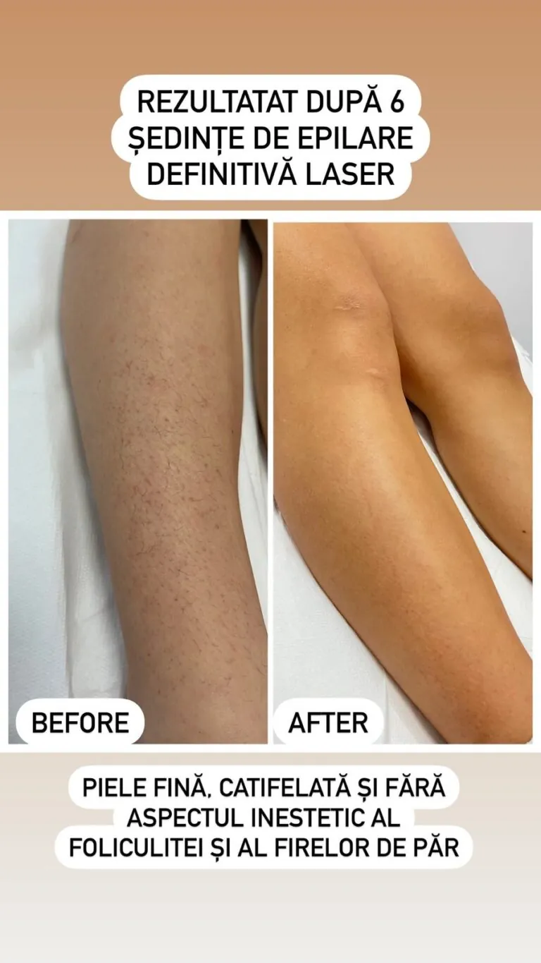 Rezultate epilare definitivă laser – înainte și după – Clinica Ababi Radu