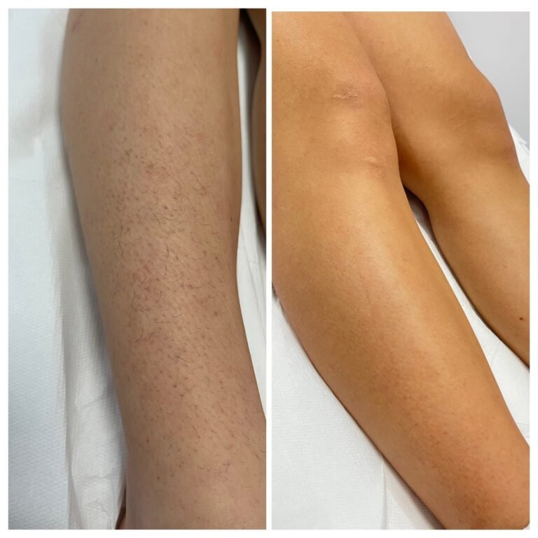 Rezultate epilare definitivă laser – înainte și după – Clinica Ababi Radu
