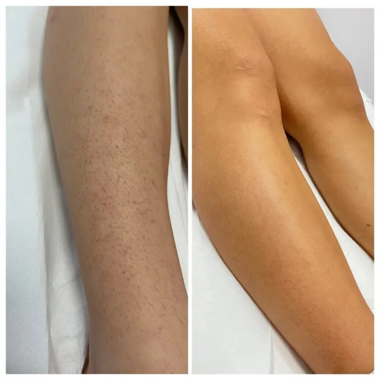 Rezultate epilare definitivă laser – înainte și după – Clinica Ababi Radu