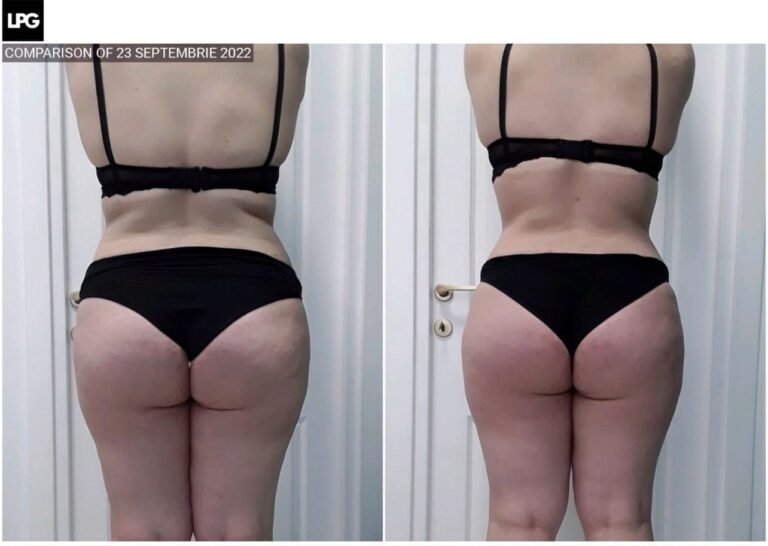 Rezultate remodelare corporală – înainte și după – Clinica Ababi Radu