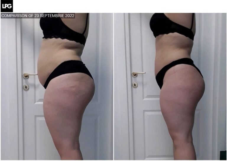 Rezultate remodelare corporală – înainte și după – Clinica Ababi Radu