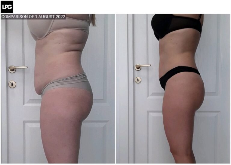 Rezultate remodelare corporală – înainte și după – Clinica Ababi Radu