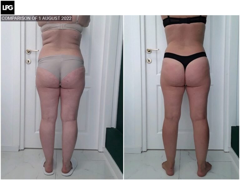 Rezultate remodelare corporală – înainte și după – Clinica Ababi Radu