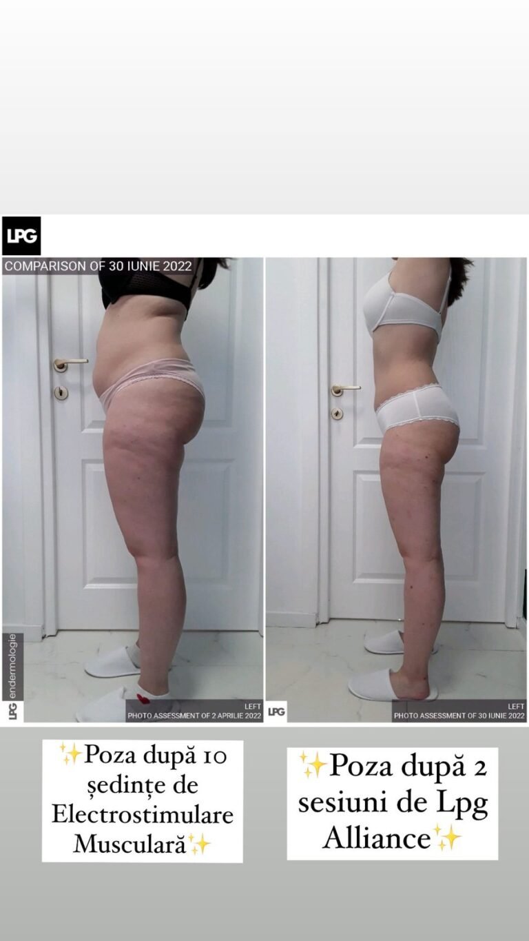 Rezultate remodelare corporală – înainte și după – Clinica Ababi Radu