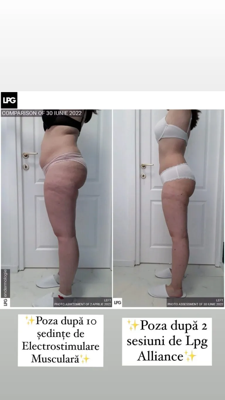 Rezultate remodelare corporală – înainte și după – Clinica Ababi Radu