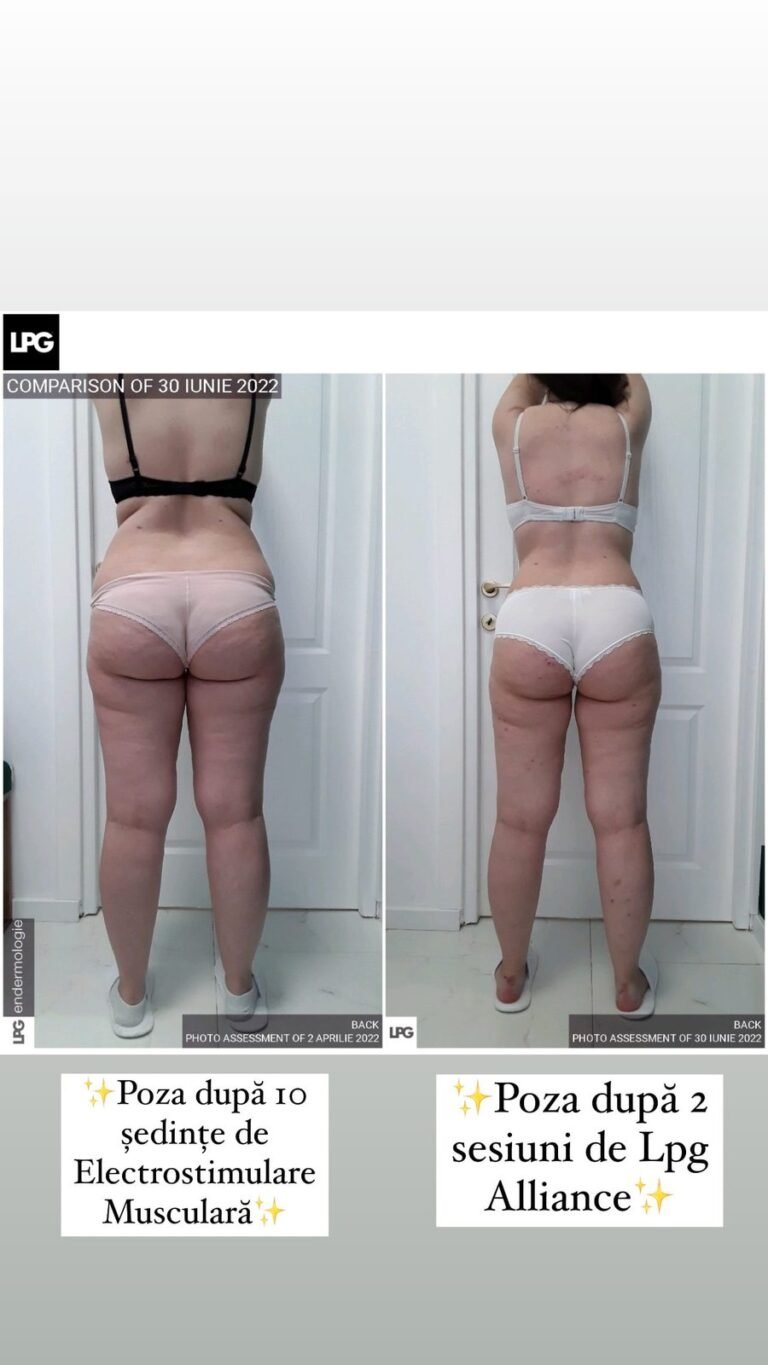 Rezultate remodelare corporală – înainte și după – Clinica Ababi Radu