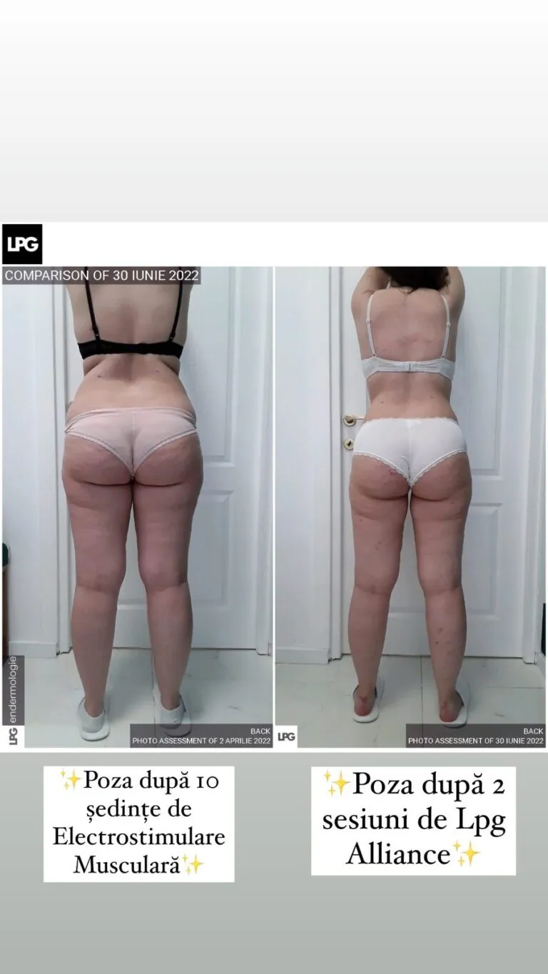 Rezultate remodelare corporală – înainte și după – Clinica Ababi Radu